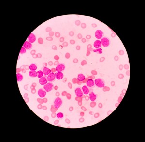 leucemia