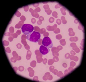 leucemia mieloide