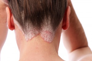 PSORIASI